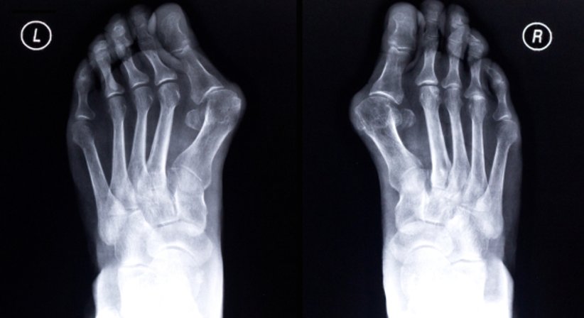 Hallux valgus - OA Dr. Michel Chraim - Orthopäde Wien 1080