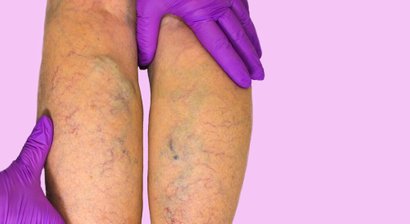 Radiofrequenztherapie