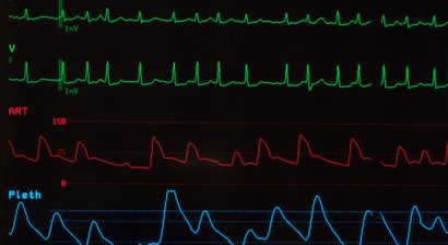 Endovaskuläre Aortensanierung / EVAR (endovaskuläre Aortenreparatur)