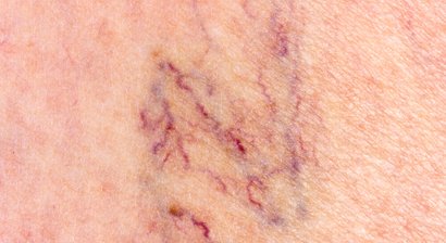 Therapie von Besenreisern