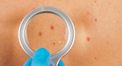 Hautkrebsvorsorge (Muttermalkontrollen)