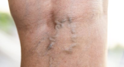 Krampfaderbehandlung (Katheteroperation/Verödung)