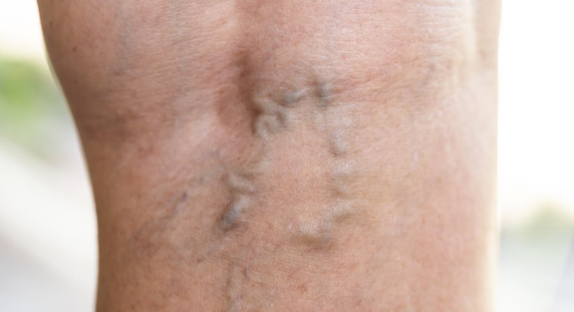Krampfaderbehandlung (Katheteroperation/Verödung) - Dr. Spiro Silvester Schuller - Hautarzt Wien 1080