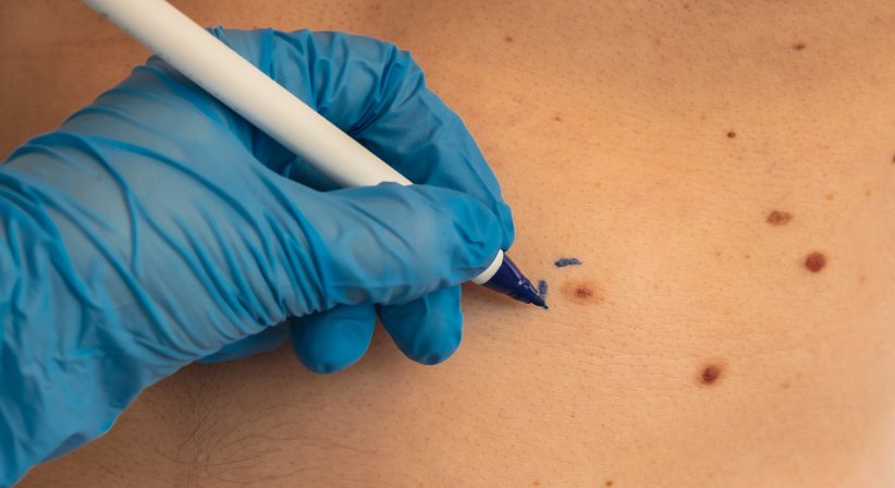 Hautkrebsbehandlung (Hautkrebs-Chirurgie)  - Dr. Spiro Silvester Schuller - Hautarzt Wien 1080