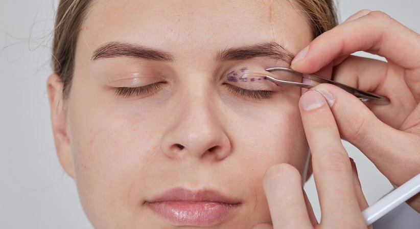 Lidstraffung (Blepharoplastik) - Dr. Spiro Silvester Schuller - Hautarzt Wien 1080