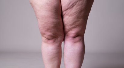 Lipödembehandlung (Fettabsaugung) 