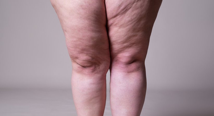 Lipödembehandlung (Fettabsaugung)  - Dr. Spiro Silvester Schuller - Hautarzt Wien 1080