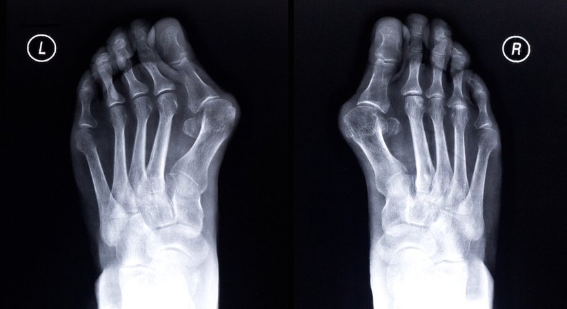 Fußoperationen - Priv. Doz. Dr. Heimo Clar - Orthopäde Graz 8010