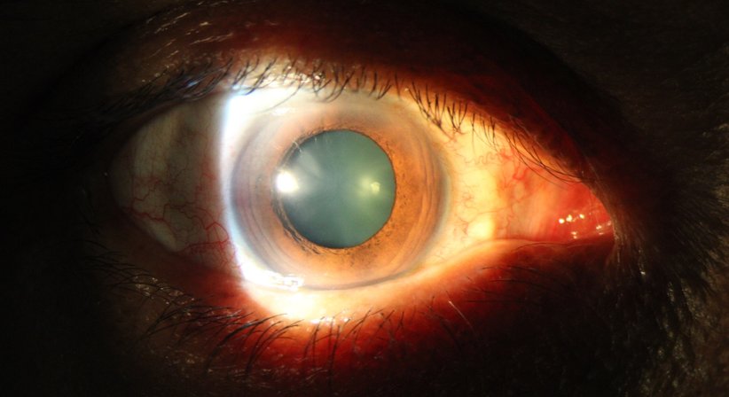 Katarakt Operationen (grauer Star) - OA Dr. Ammar Alkhalde, FEBO - Augenarzt Wien 1210