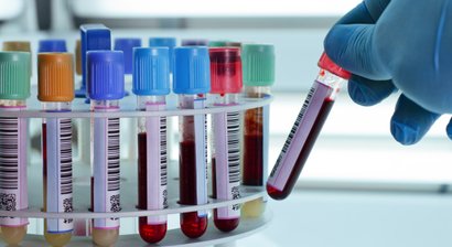 Eigenbluttherapie (PRP)