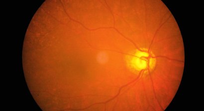 Diabetische Retinopathie