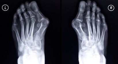 Hallux valgus