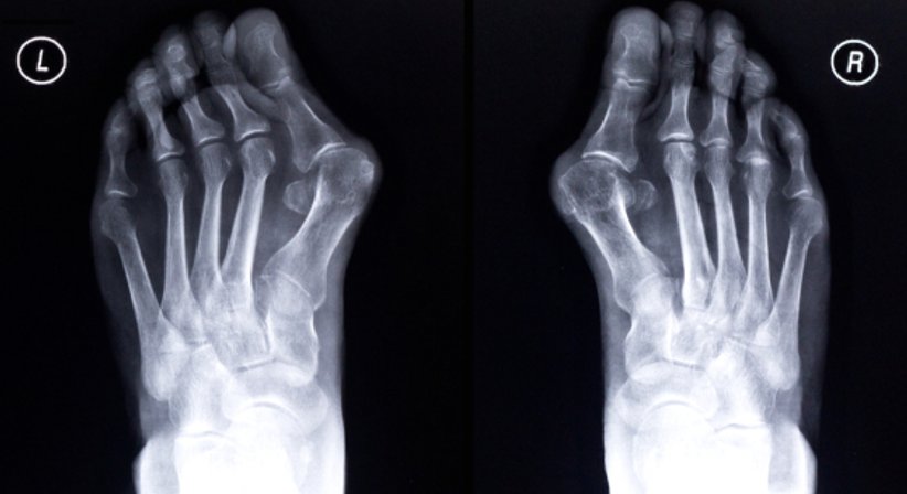 Hallux valgus - OA Dr. Lukas Karamat - Orthopäde Wien 1030
