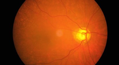 Diabetische Retinopathie