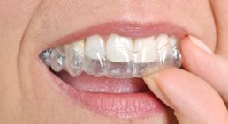 Invisalign -