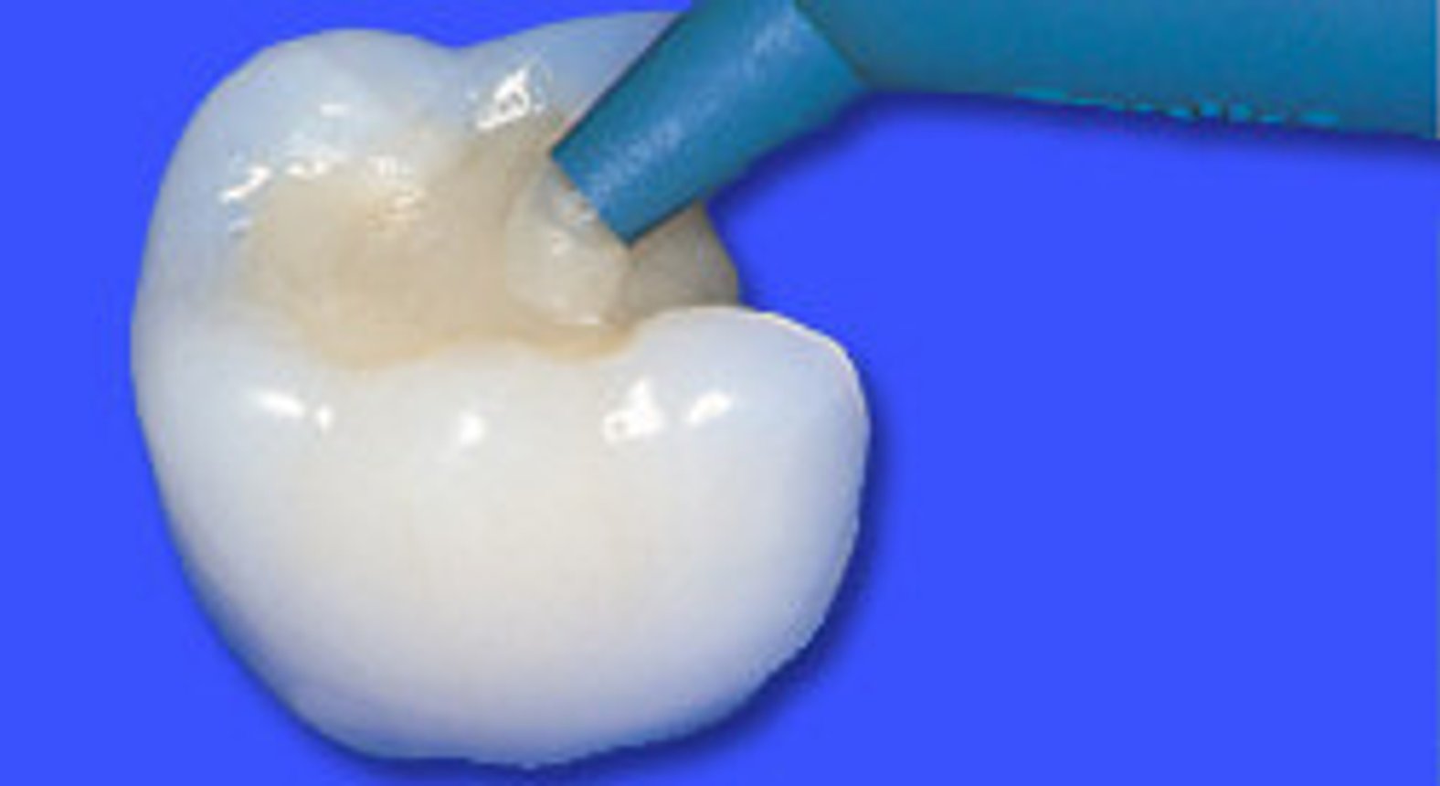 Dr. Alexander Kremsner - Füllungen | Zahnarzt in 3430 Tulln an der ...