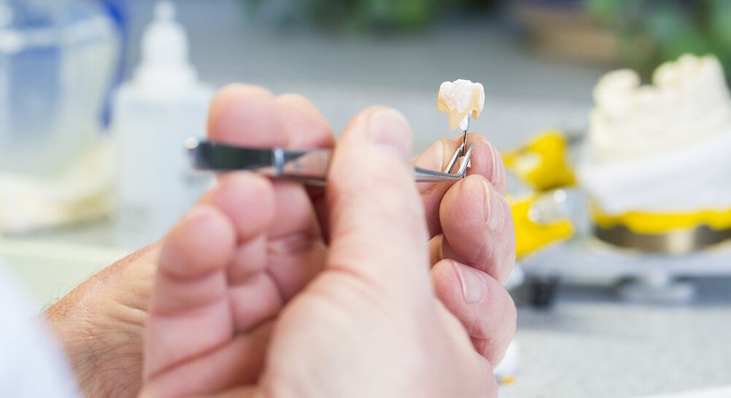 Inlays und Onlays - Dr. Clemens Ganger - Zahnarzt Wien 1140