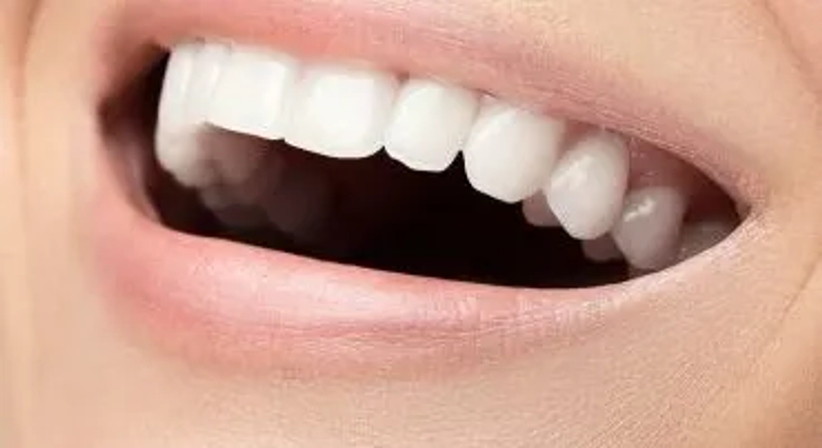 Bleaching bei Dr. med. dent. Yi Kittl