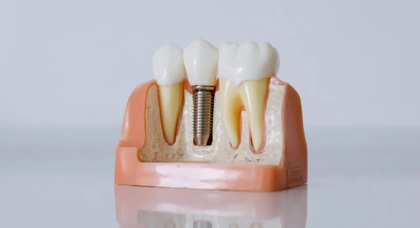 Implantologie bei Dr. med. dent. Yi Kittl