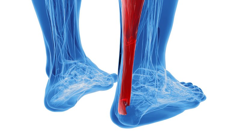 Tendinopathie der Achillessehne - Dr. Philippe Reuter, MSc - Orthopäde Brunn am Gebirge 2345