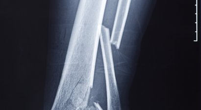 Konservative und operative Frakturbehandlung