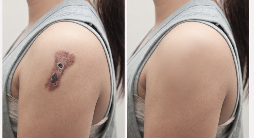 Hauttumore - Prof. Priv. Doz. DDr. Lorenz Kadletz-Wanke - HNO-Arzt Wien 1040