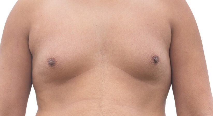 Gynäkomastie - Priv. Doz. Dr. Alexandra Sibylle Fochtmann-Frana - Plastische Chirurgin Wien 1050