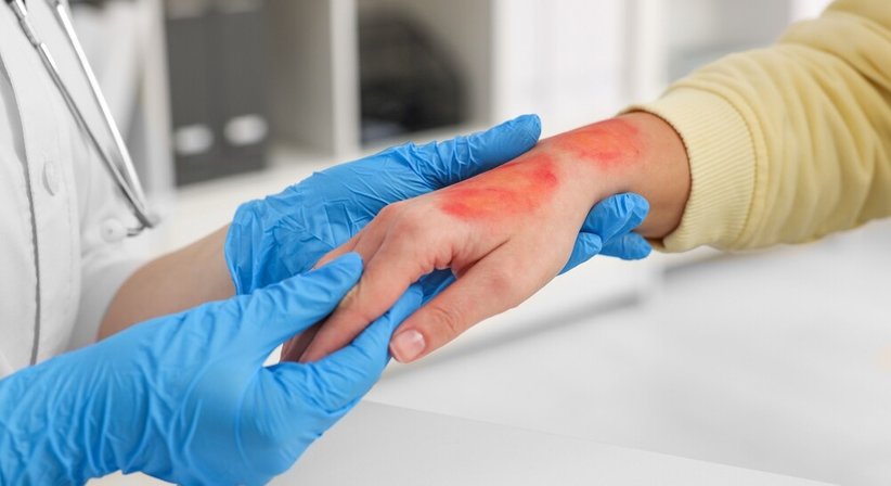 Behandlung nach Brandverletzung - Priv. Doz. Dr. Alexandra Sibylle Fochtmann-Frana - Plastische Chirurgin Wien 1050