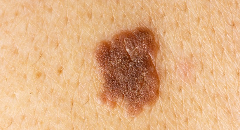 Entfernung von Hauttumoren - Priv. Doz. Dr. Alexandra Sibylle Fochtmann-Frana - Plastische Chirurgin Wien 1050