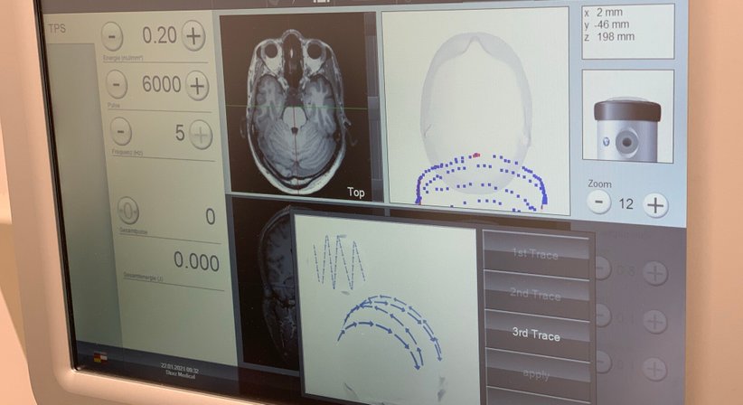 Transkranielle Pulsstimulation bei Alzheimer Demenz - Dr. Matthias Geisler - Orthopäde Wien 1220