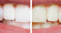 Bleaching -