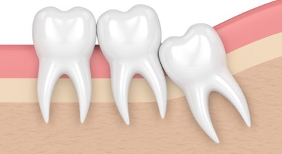 Entfernung von Weisheitszähnen