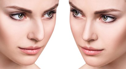 Nasenkorrekturen / Gesichtsprofilkorrekturen / Lippenkorrekturen