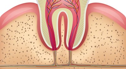 Wurzelspitzenresektion