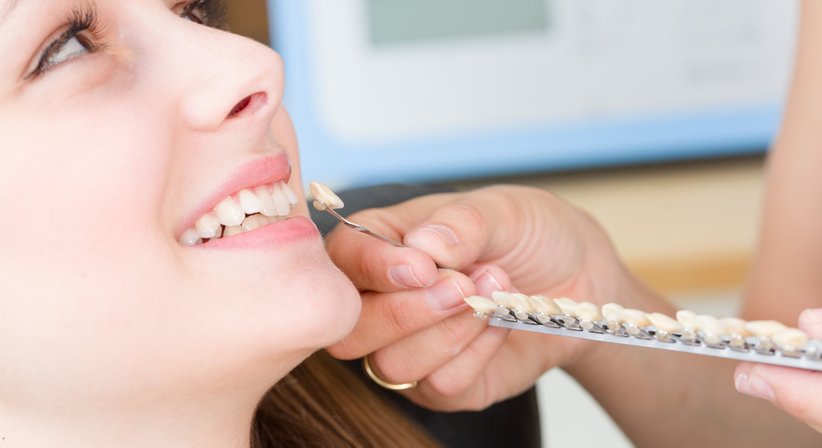 Veneers - Dr. Irene Seemann - Zahnärztin Wien 1080