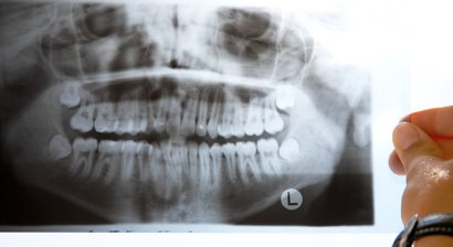 Digitale Volumentomographie (DVT, 3D-Röntgen)