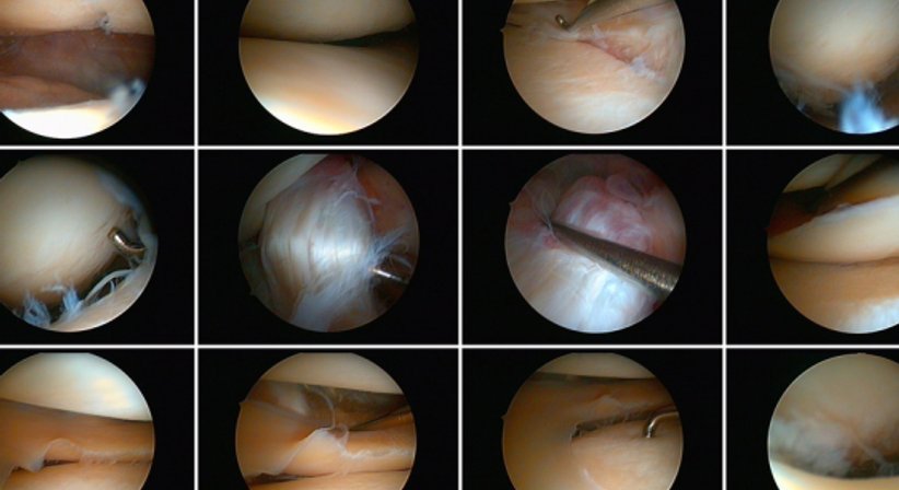 Arthroskopie / Arthroskopische Operationen - OA Dr.med.univ. Florian Frisee - Orthopäde Wien 1190