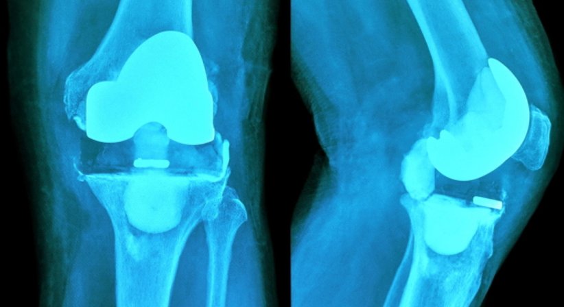 Knietotalendoprothese - OA Dr.med.univ. Florian Frisee - Orthopäde Wien 1190