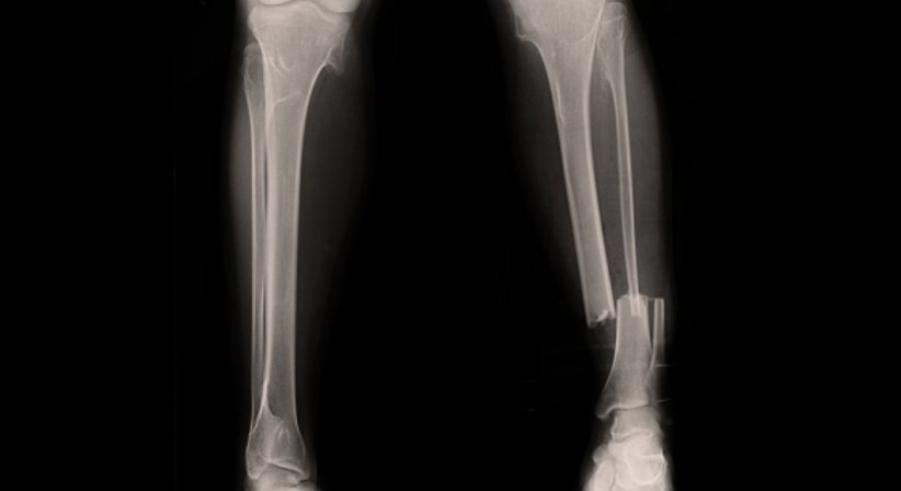 Konservative und operative Knochenbruchbehandlungen - OA Dr.med.univ. Florian Frisee - Orthopäde Wien 1190