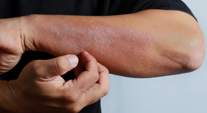 Entzündliche Hauterkrankungen