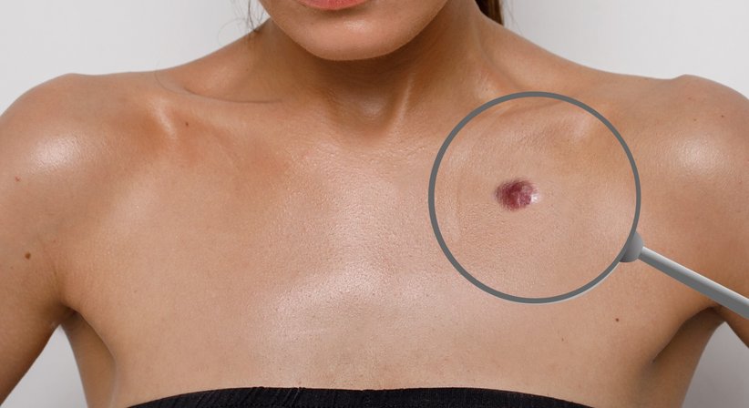  Behandlung von Hämangiomen (Blutschwämmchen) - Dr. Philipp B. Weber - Hautarzt Wien 1180