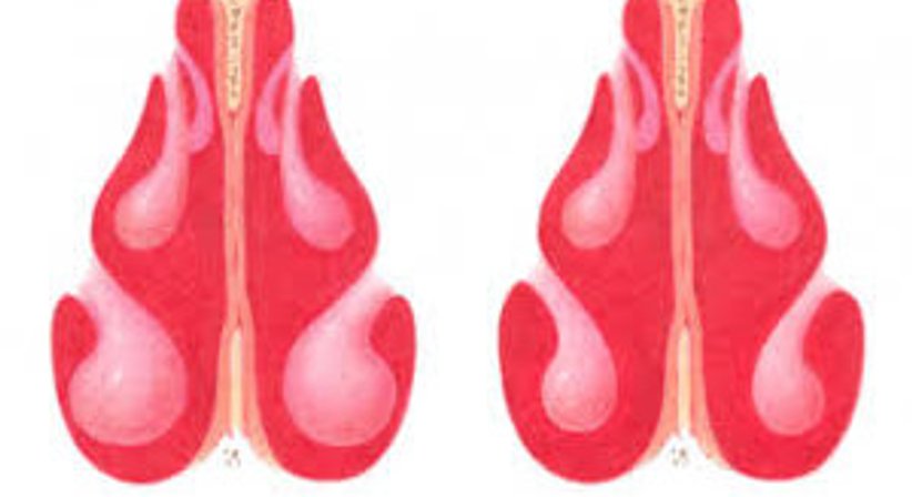 Turbinoplastik - Priv.-Doz. Dr. Dr. Faris Brkic - HNO-Arzt Wien 1190