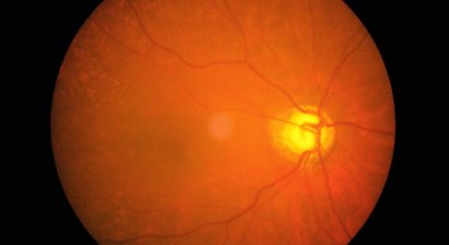 Netzhauterkrankungen und Behandlung von Gerstenkörnern