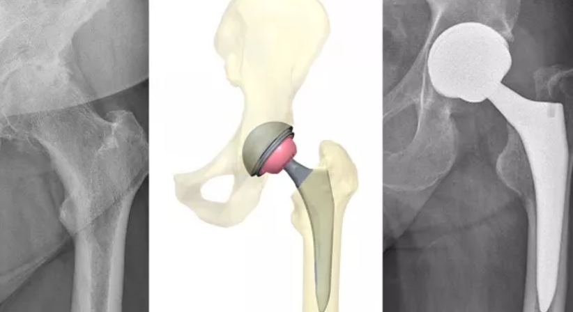 Hüftprothese - OA Dr. Clemens Hüthmair - Orthopäde Wien-Flughafen 1300