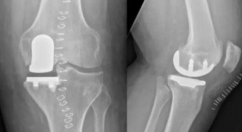 Knieprothese - OA Dr. Clemens Hüthmair - Orthopäde Wien-Flughafen 1300