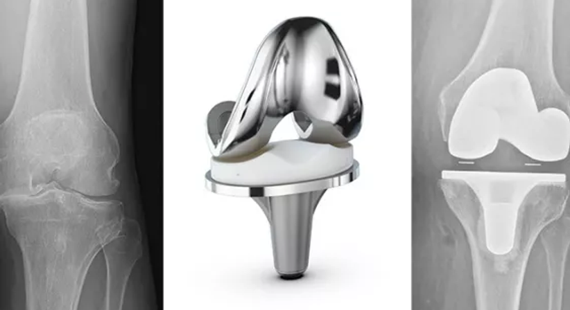 Knieprothese - OA Dr. Clemens Hüthmair - Orthopäde Wien-Flughafen 1300