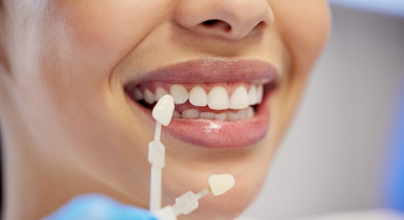 Veneers - Dr. med. dent. Agnes Salamon - Zahnärztin Wien 1020