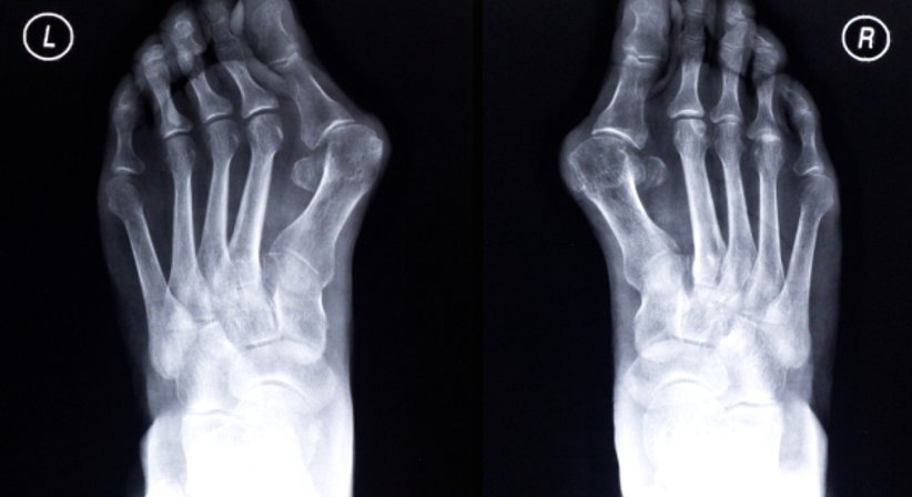 Fußchirurgie - Dr. Rudolf Kramer - Orthopäde Wien 1210