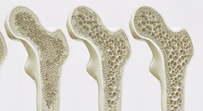 Osteoporose (Knochenschwund)