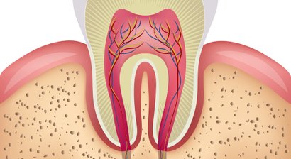 Wurzelbehandlung / Wurzelspitzenresektion